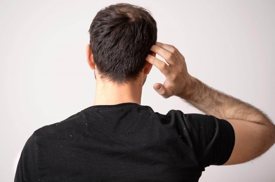 Homem de costas passando a mão em seu cabelo sofrendo com os sintomas da caspa.